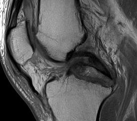 PCL Bony Avulsion MRI